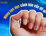 Tại sao móng tay bị sọc dọc? Móng sọc dọc cảnh báo vấn đề gì?