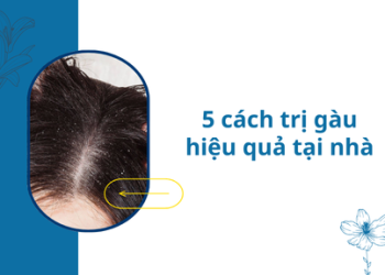 Cách trị gàu cho nữ tại nhà hiệu quả: Tạm biệt “tuyết rơi” sau 2 tuần